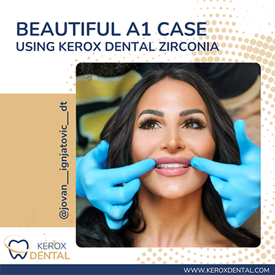 Beautiful A1 Case - Kerox Dental news