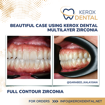 Beautiful case using Kerox Dental - Kerox Dental news
